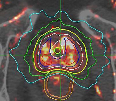 High Dose “HDR-Like” Prostate SBRT: PSA 10-Year Results From a Mature, Multi-Institutional Clinical Trial